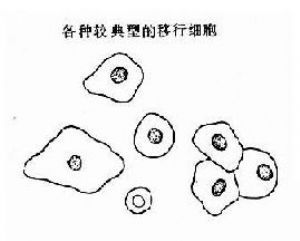 移行上皮细胞:涂片中表层细胞体积大,呈扁圆形或多边形,胞膜光滑,可见