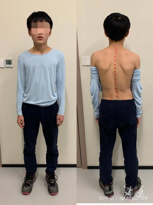 脊柱侧弯少年的改变