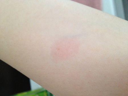 用尺量红的范围大约直径1cm 这样是阳性还是阴性?