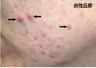 炎性丘疹,炎性痘痘的具体症状和症状图