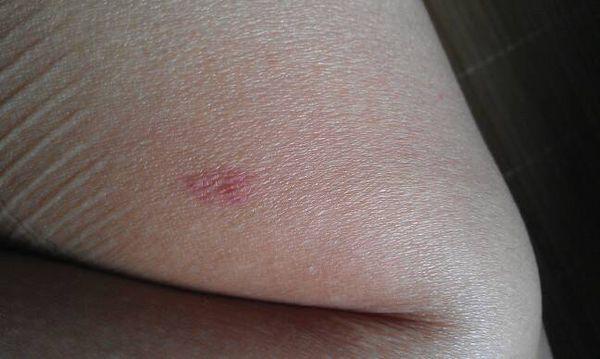 你好,我想问下紫癜这个要怎么治疗?还有就是老是下吧长痘!