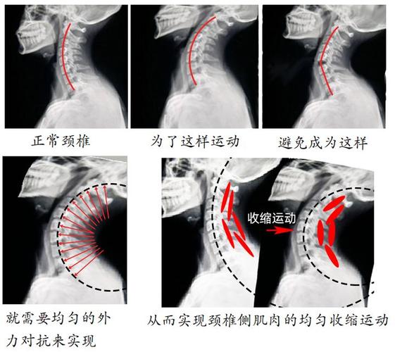 下图比较形象,通过颈椎弧度圈的缩小过程中,依据生理曲度增加外力对抗
