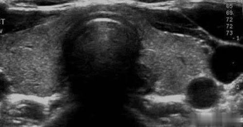 甲状腺正常声像图 测量方法 纵切:上下径 横切:横径,前后径 参考值