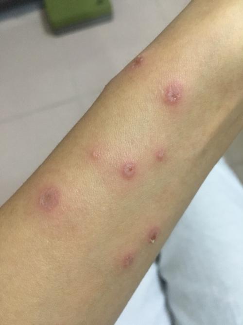 这种是湿疹还是水痘还是什么,一开始两只手臂上,现在腿上也长了,有点