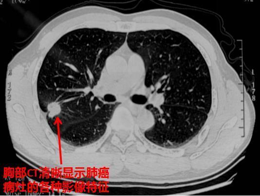 胸部ct清晰显示肺癌病灶的各种影像特征
