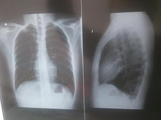  p>胸透称荧光透视,为常用x线检查方法.