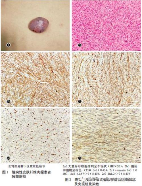 隆突性皮肤纤维肉瘤30例临床分析隆突性皮肤纤维肉瘤医脉通