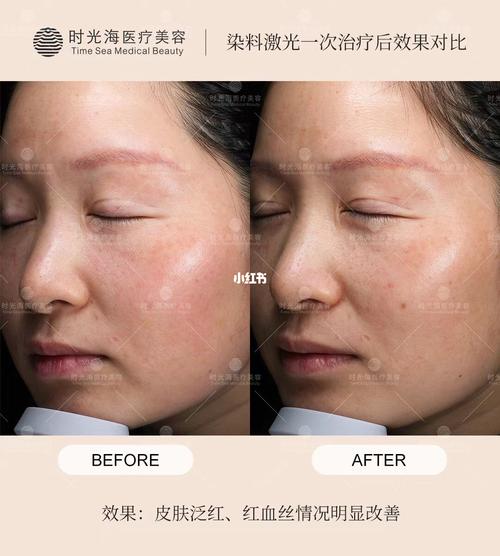 染料激光改善血管型黄褐斑_黄褐斑_敏感肌_美肤_红血丝修复_淡化色斑