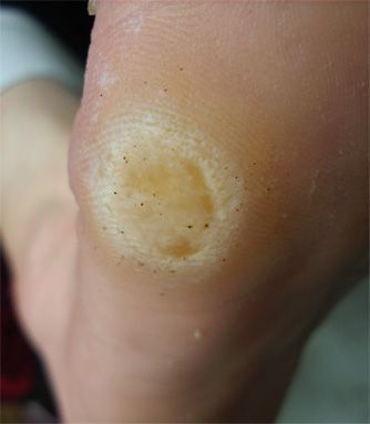 [转载]脚垫,老茧 治疗方法