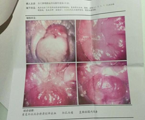 27号 诊断 :重度环状混合痔溃烂伴出血 肛乳头瘤 直肠粘膜内脱垂 