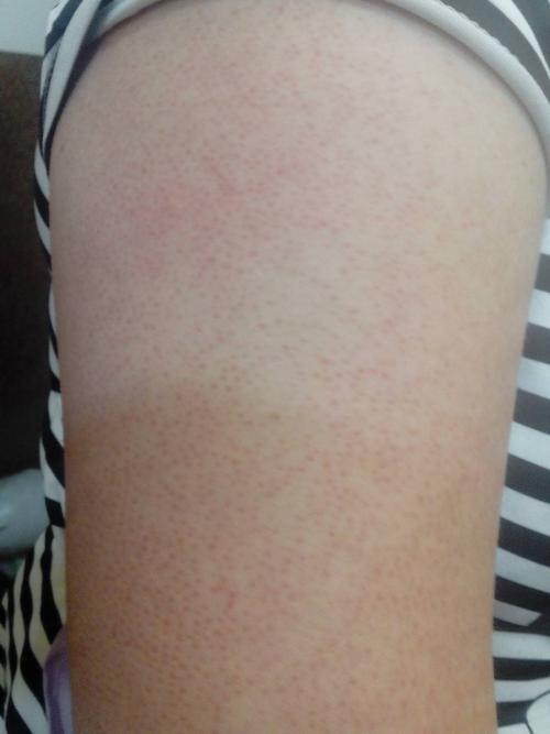 问:这是毛囊炎吗?不痛不痒 太热了就会越来越红