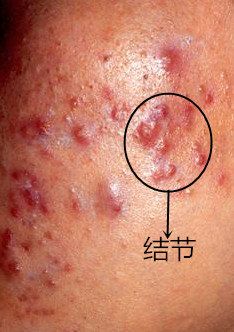 如何分辨青春痘吗?