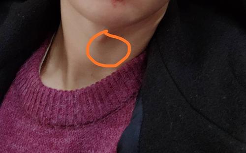 喉结下方有一个鼓包是怎么回事