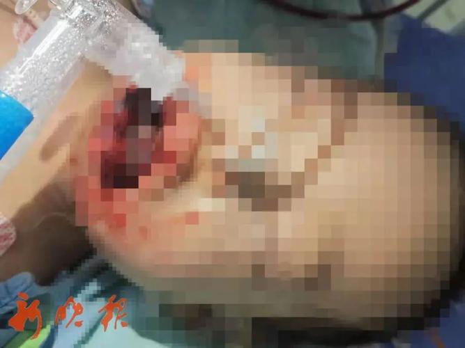 舌头喉咙全烂了 男孩误吞"毒零食" !