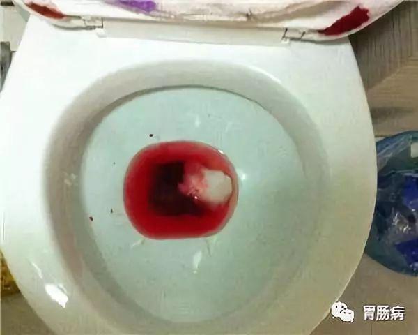 痔疮和直肠癌都会便血,如何鉴别?