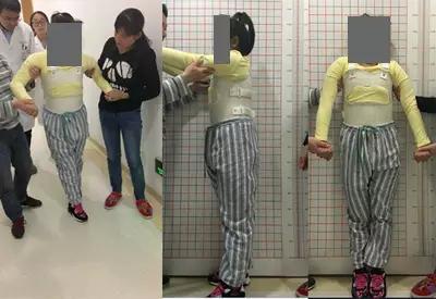 讨论脊柱侧后凸畸形特点:1,多由先天性椎体畸形引起;2,发病率低但