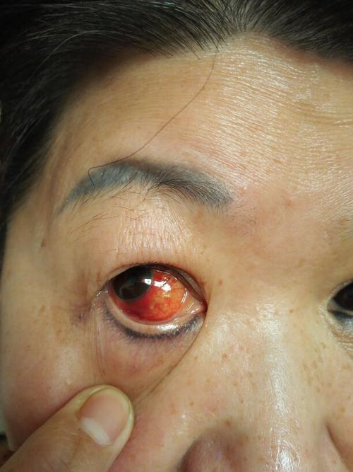 我妈妈的眼睛突然结膜充血,自己没有碰到眼睛,她正在使用氧佛沙星