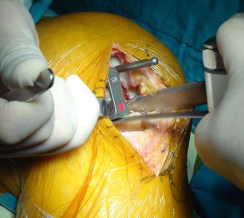 小手术解决膝盖大问题--活动半月板膝关节单髁关节置换术