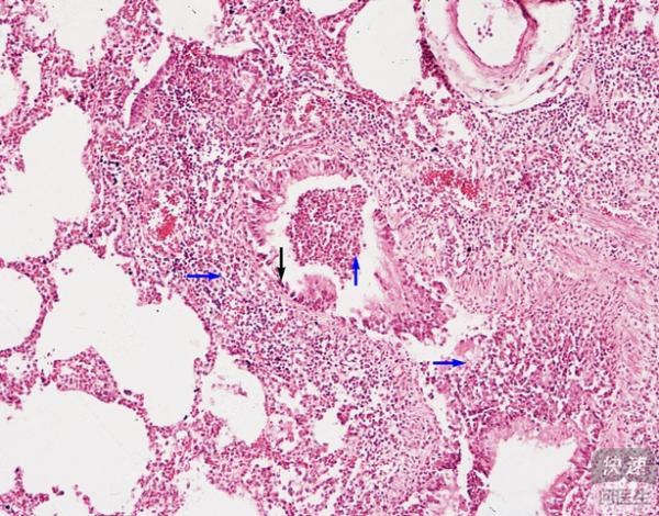 小叶性肺炎的治疗方法 怎样治疗小叶性肺炎?