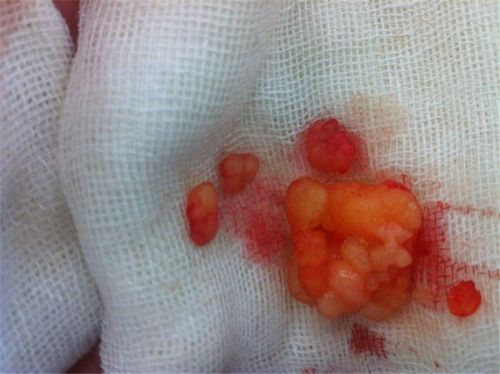 手臂皮下脂肪瘤图片