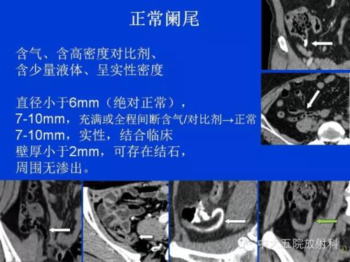 全面讲解 | 正常阑尾和阑尾炎的ct表现