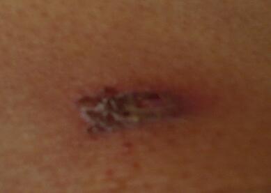 褥疮症状图片是怎么样的