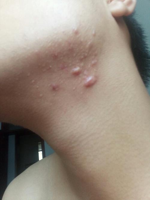 痘痘变成个硬邦邦的肉瘤