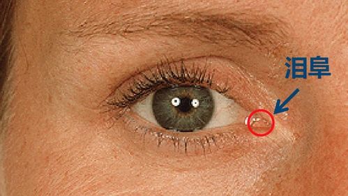 很久之前我就发现,自己右眼内眼角处的红肉(泪阜)比左眼要大不少,但是