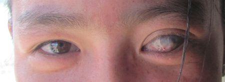 眼球表面有白色膜状物覆盖,眼底有血丝