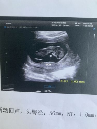 nt秒过,宝宝姿势和别人的不一样_nt检查_母婴_孕产经验