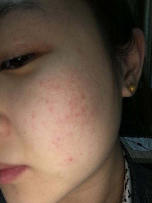 脸这种情况2个月了,去了2个皮肤病医院看说是过敏性皮炎,可是用药皮肤