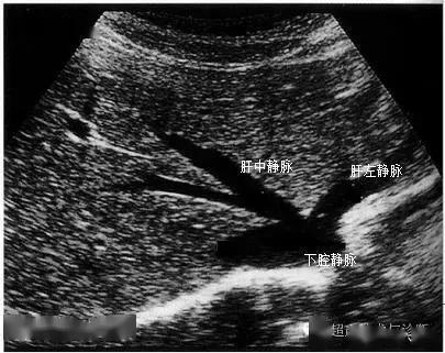 「微课堂」肝脏超声标准切面及主要解剖注释