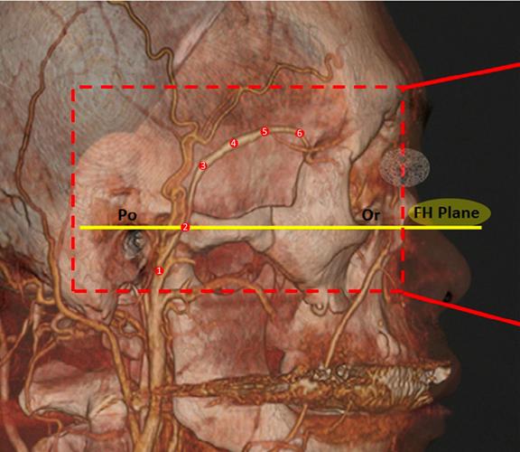 脑血管解剖学习笔记第18期:颧眶动脉