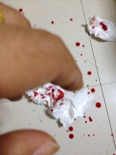 问:手指被刀片割伤需要打破伤风吗?流了不少血