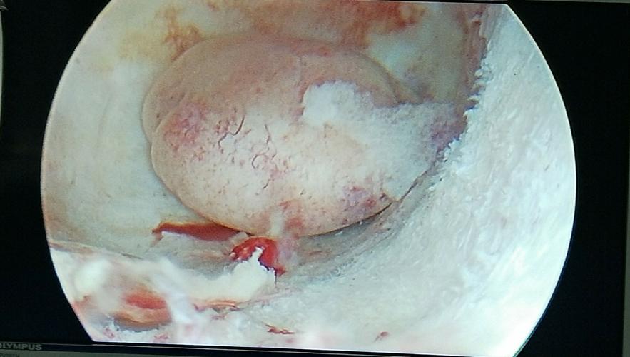 榆林一院病例分享 –异常子宫出血宫腔镜手术治疗