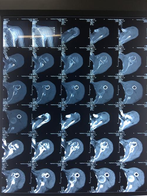 永城市中心医院骨二科成功完成一例人工肩关节置换手术