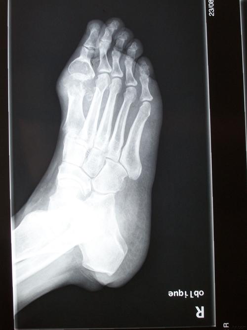 多发痛风结石,骨质有破坏