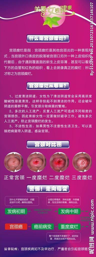 宫颈糜烂的危害x展架图片