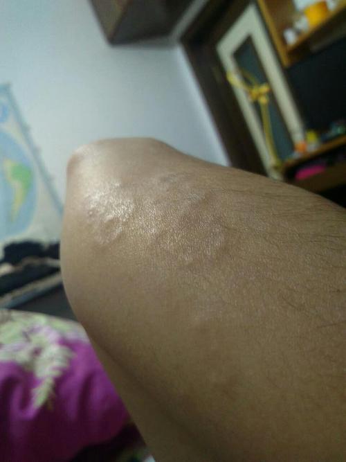  p>环状肉芽疮是一种少见的良性慢性皮肤病.