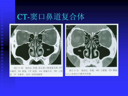 版权属于课件中老师 仅供学习 ct-窦口鼻道复合体