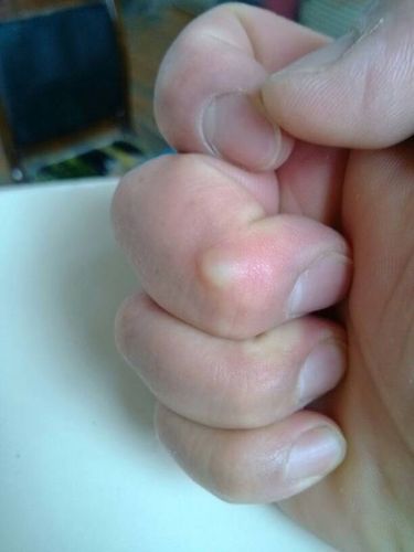 右手中指第一节出现囊肿 右手中指第一节关节肿痛,握拳时感觉明显