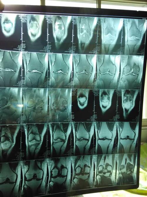 问:如果半月板损伤保守治疗要吃些什么药?