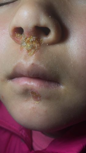 我家孩子上小学一年级,今年春天鼻子下面生了一圈的疮