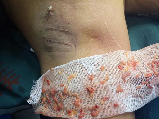 微创腋臭手术~让生活不再尴尬