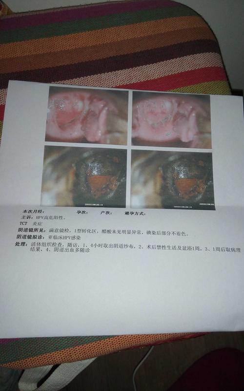 就是用碘染后部分不着色,正常的是都着色,不着色的地方就有问题.