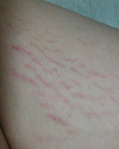 大腿上长肥胖纹图片 (第1页)