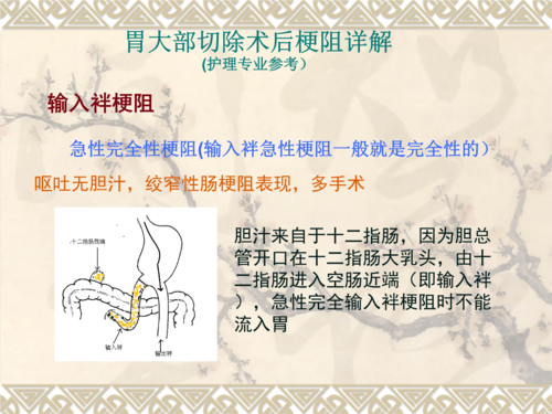 胃大部切除术后梗阻11.ppt