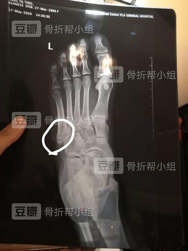 第五跖骨基底部骨折