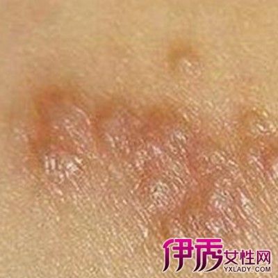 【图】展示疥疮结节图片 你了解疥疮结节的治疗方法是什么吗?