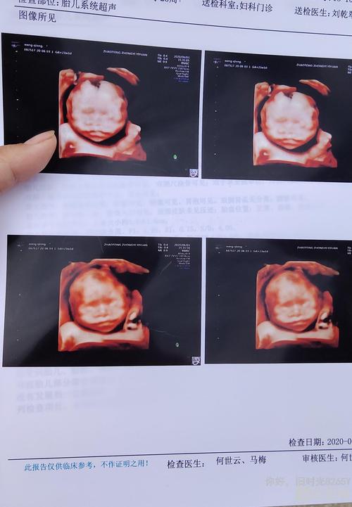 四维没通过胎儿上唇发现暗带不知道怎么回